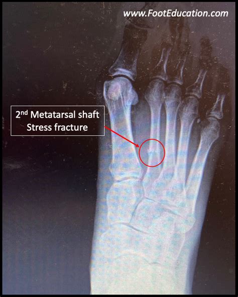 2nd Metatarsal Stress Fractures - FootEducation