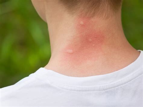 Natural Remedies for Mosquito Bites - Soulguru