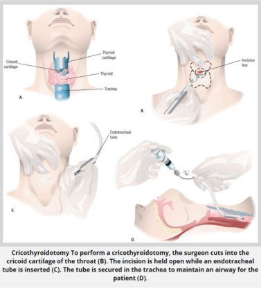 Cricothyroidotomy Procedure 4 Hazardous Risks - MKExpress.net