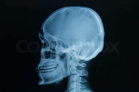 skull x-rays image | Stock image | Colourbox