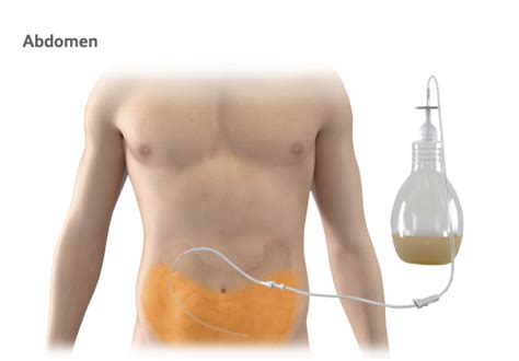 Tunneled Drainage Catheter: A Guide for Effective Management