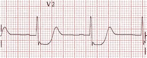 Posterior Myocardial Infarction • LITFL • ECG Library Diagnosis