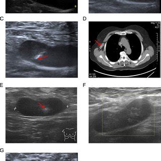 The procedure for marking the biopsy-proven metastatic lymph nodes with... | Download Scientific ...