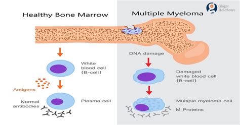 Bone Cancer: Symptoms, Causes, Diagnosis, Types & Treatment options