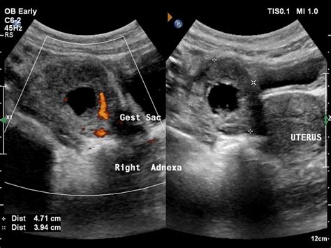 Ectopic Pregnancy Ultrasound