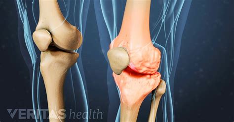 What is Crepitus? | Arthritis-Health