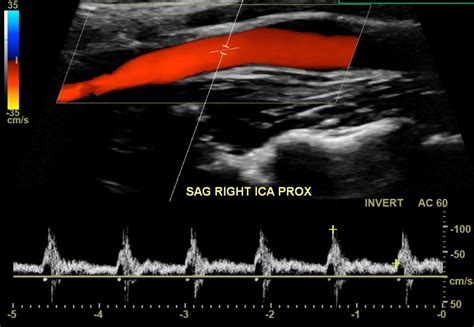 Carotid bruit: What is it? What causes it? Will I have a stroke?