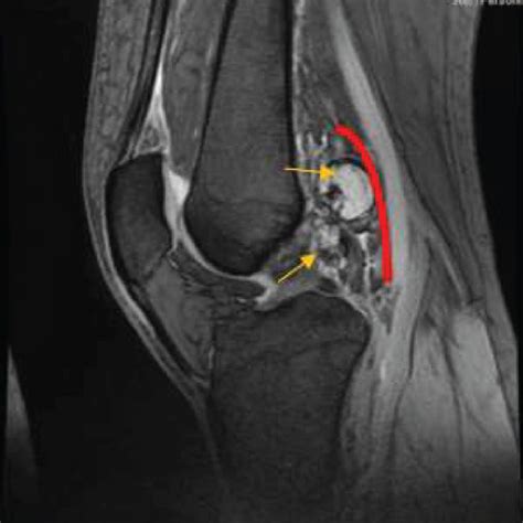 (a) Lateral-view T2 sequence MRI of the left knee showing a ...