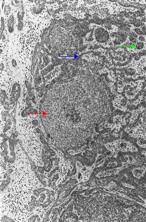 Cureus | Trichoblastomas Mimicking Basal Cell Carcinoma: The Importance ...