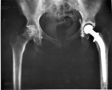 Stryker Recalls Hip Implants for Taper Lock Failure Risk - Daily Hornet ...