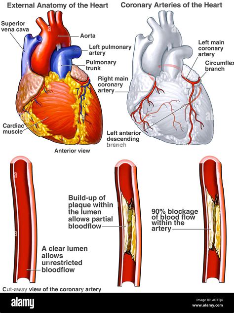 Herzen - Herzkranzgefäße mit möglichen Blockaden Stockfoto, Bild: 7710243 - Alamy