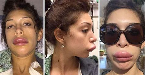 19 Freaky Cases of Lip Injections Gone Wrong