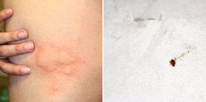 Pictures of Bed Bugs Bites on Real People | Debedbug