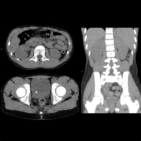 Genitourinary – Pediatric Imaging