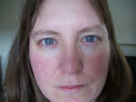 Rosacea | What is Rosacea