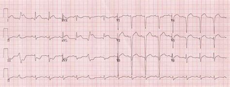 High Lateral STEMI • LITFL • ECG Library Diagnosis