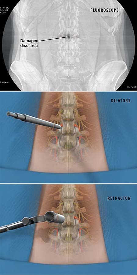 TLIF mínimamente invasivo (fusión transforaminal inter-corporal lumbar ...