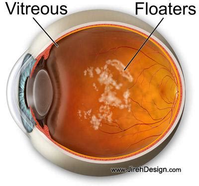 What are floaters in the eye? A detailed patient guide to eye floaters