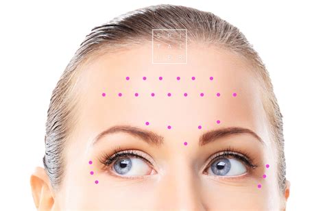 Botox Injections | Docteur Spitalier