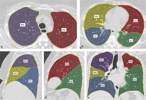 4 Lungs | Thoracic Key