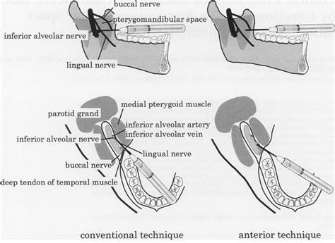 INJECTION SITES | Local Anesthesia | Pinterest | Dental, Dentistry and Dental hygiene