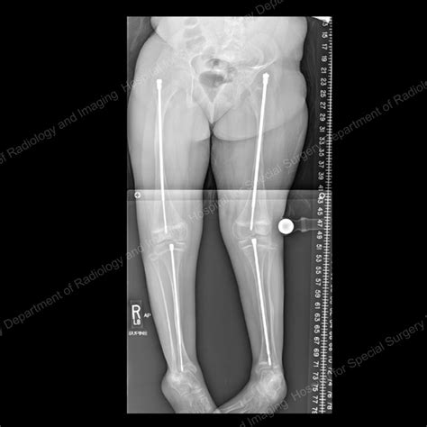 Osteogenesis Imperfecta Treatment