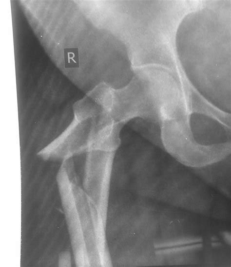 Subtrochanteric Fractures - Trauma - Orthobullets