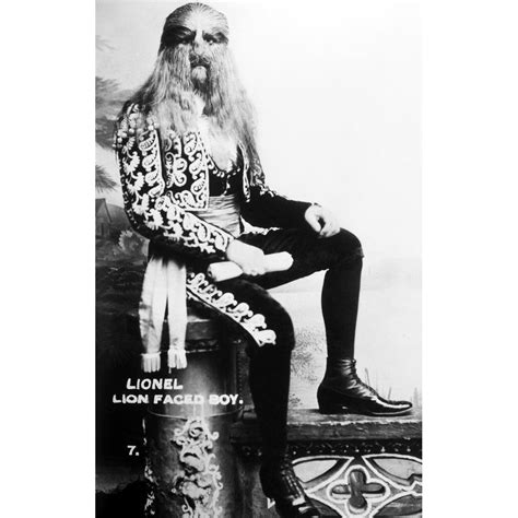 Lion-Faced Man 1907 Nstephan Bibrowsky (1890-1932) Known As Lionel The ...