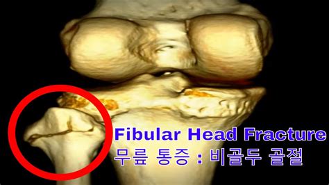 Fibular Head Fracture 무릎 통증 : 비골두 골절 - YouTube