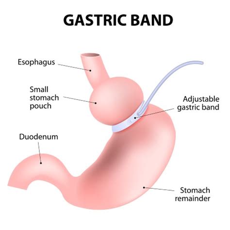 Lap Band Complications - How Safe Is Lap Band Surgery? | BMCC