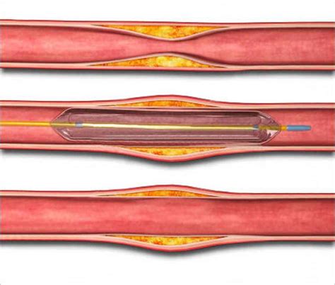 Balloon Angioplasty | Conic Vascular