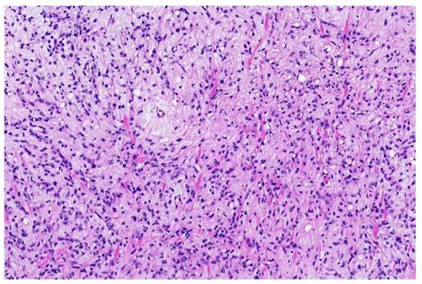 Myxoid liposarcoma showing different stages of primitive fat cells.... | Download Scientific Diagram