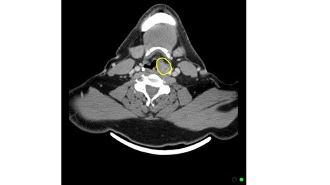 Hypopharyngeal Cancer