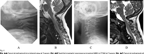 Figure 4 from Surgical Treatment of Chondrodysplasia Punctata Tibial-Metacarpal Type Until ...