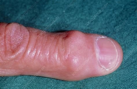 Heberden's node on finger in osteoarthritis - Stock Image M110/0271 ...