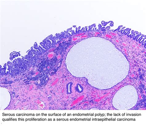 Pathology Outlines - Serous carcinoma