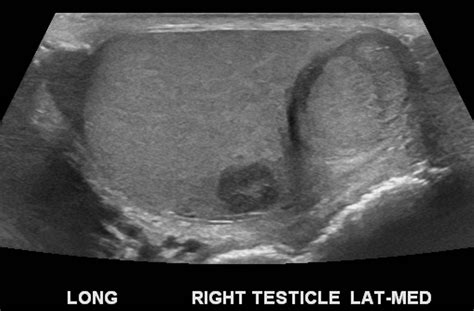 Cureus | Synchronous Bilateral Primary Testicular Tumors With Discordant Histopathology