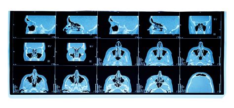 How Do I Prepare For A Sinus CT Scan | South Jersey Radiology