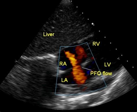 PFO-flow – All About Cardiovascular System and Disorders