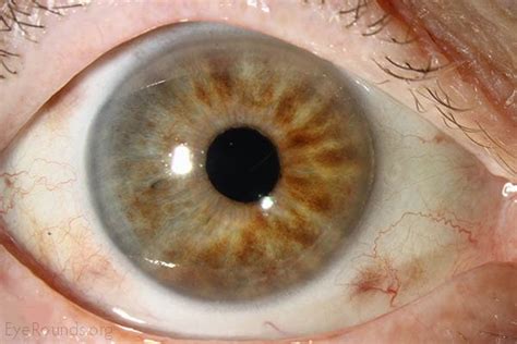 Ocular melanocytosis