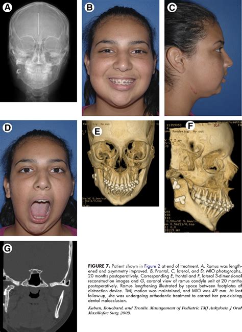 Temporomandibular joint aspiration | Semantic Scholar