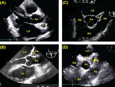 The transverse and oblique sinuses of the pericardium: Anatomic and echocardiographic insights ...