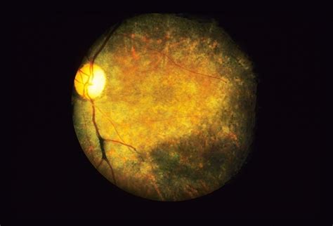 Bull's Eye Maculopathy / Chloroquine - Retina Image Bank