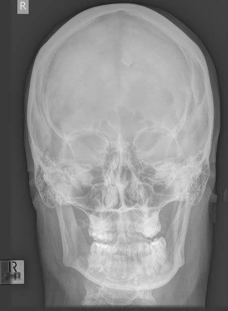 Mastoiditis X Ray