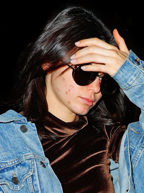 When did Kendall Jenner have acne? | The US Sun