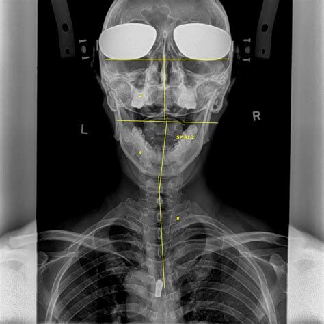 What are X-rays? | ALL WELL Scoliosis Centre - Singapore Chiropractic Clinic