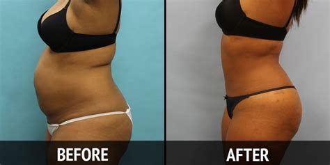 How Does Liposuction Work and is it Right For Me? - Women Daily Magazine