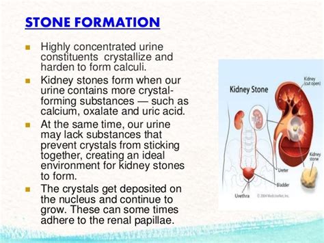 Presentation kidney-stone final