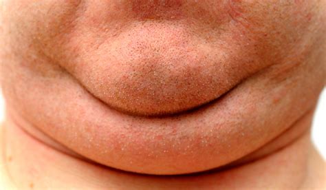 New Drug to Eliminate the Double Chin, Sans Surgery - Newsweek