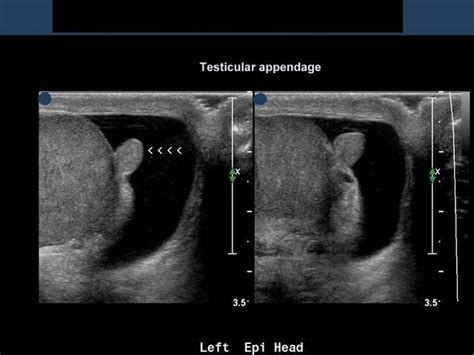 cochinblogs: 3-D ultrasound image of appendix of testis: